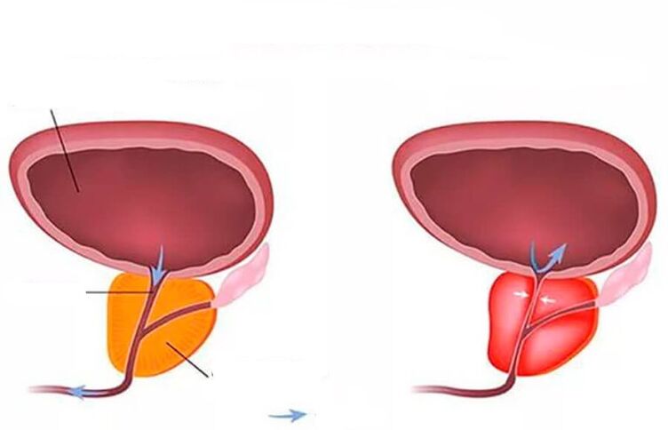 normální a zapálená prostata