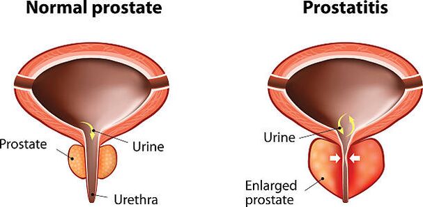 normální a zapálená prostata