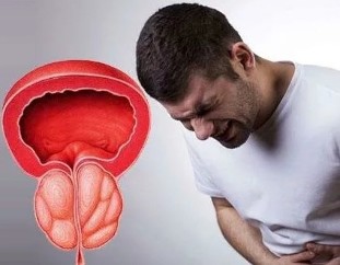 Příznaky chronické prostatitis u mužů
