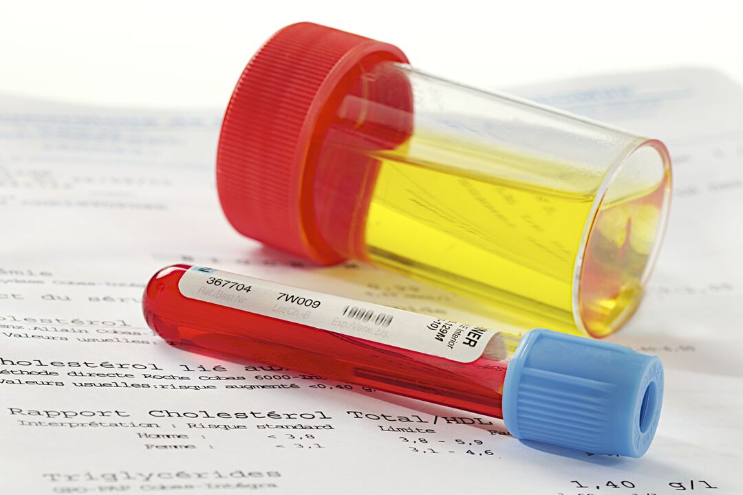 Test krve a moči pomůže určit přítomnost prostatitidy. 