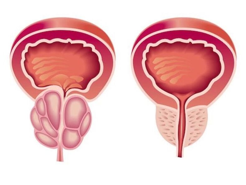 prostatitida
